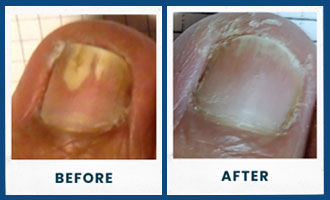 toefx before and after