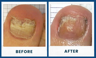 toefx before and after