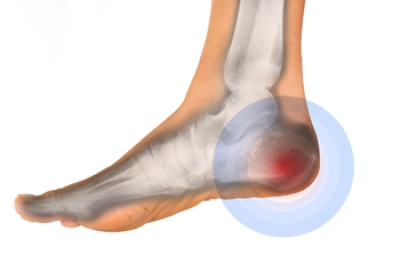 Causes and Treatment of Heel Bone Fractures