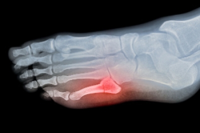 Focus on Metatarsal Shaft Fractures