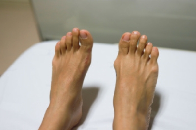 Symptoms and Treatment of Bunions